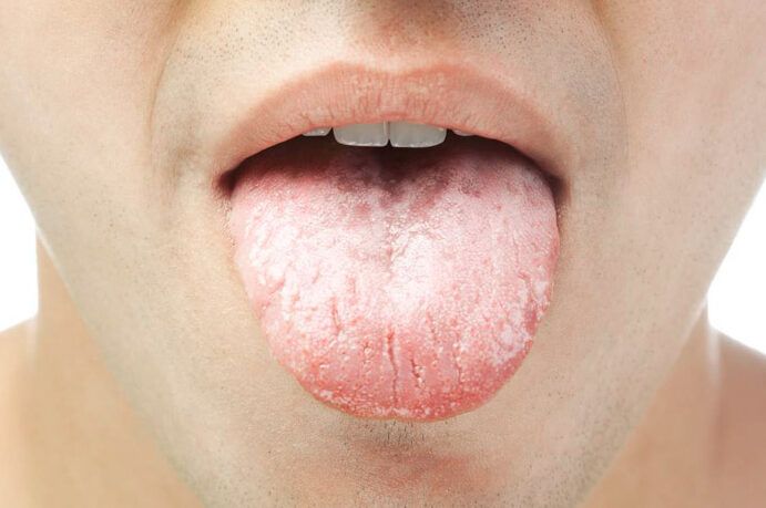 Las cinco cosas que tu lengua te puede estar diciendo sobre tu salud
