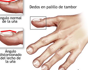 dedos malformados y tratamiento