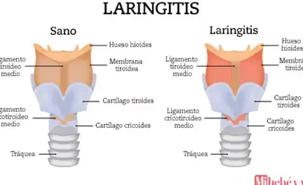 laringitis en ninos