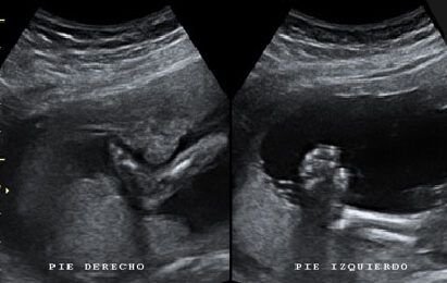 ecografia detectando malformaciones fetales